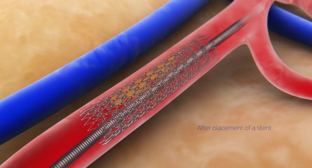 Volcano verrata placement stent